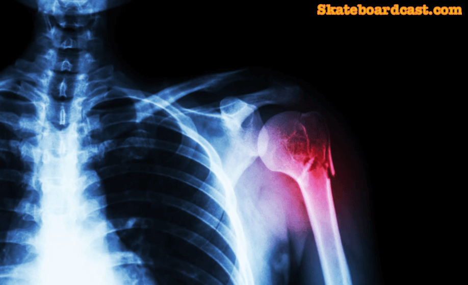 An x-ray image of a person with a shoulder injury from skateboarding.